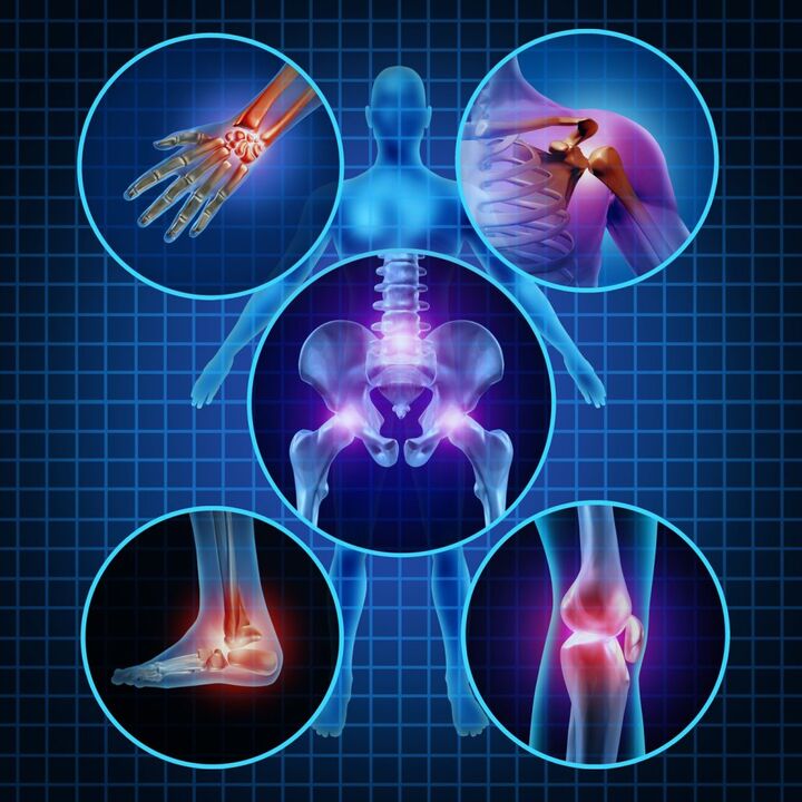 kĺbov postihnutých artrózou