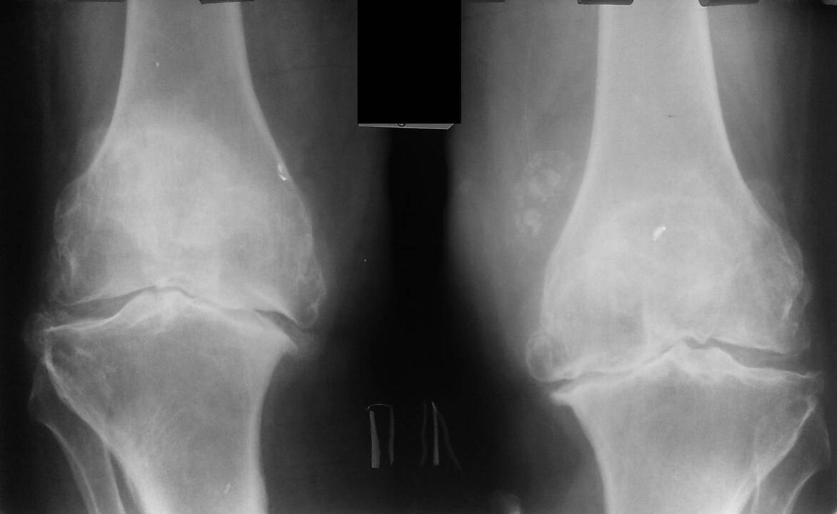 röntgen kolenných kĺbov s artrózou