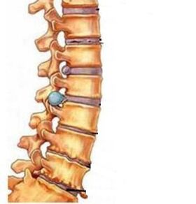 Ako sa vyvíja osteochondróza krčnej oblasti
