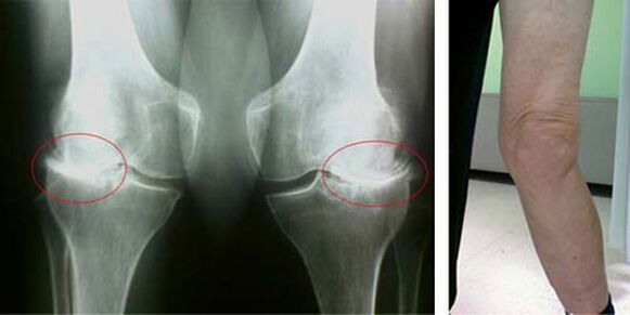 artróza kolena röntgen