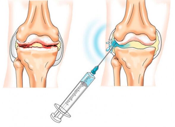 intraartikulárne injekcie na artrózu kolena