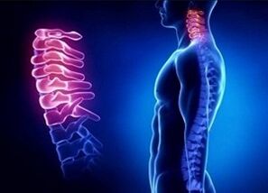 Dôvody rozvoja krčnej osteochondrózy