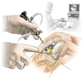 Objasnenie diagnostiky artrózy Dash Medicine