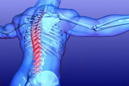 osteochondróza bedrovej chrbtice