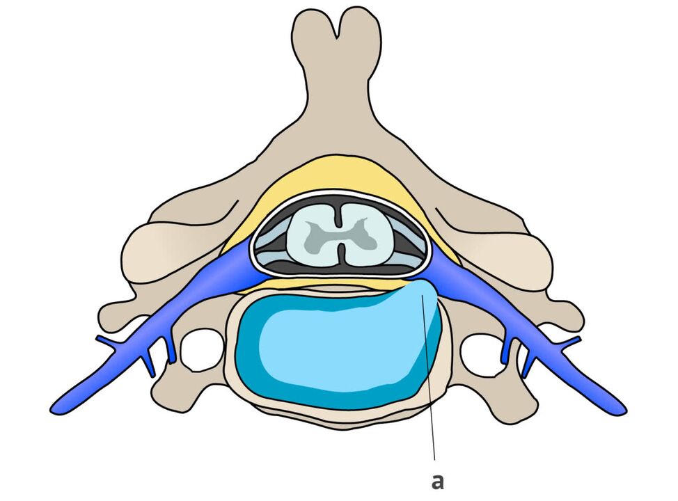 intervertebrálna hernia s cervikálnou osteochondrózou