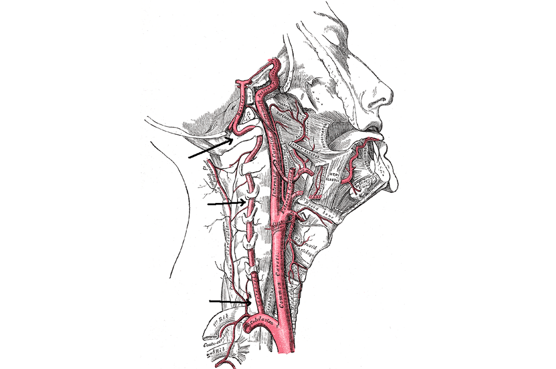 kompresia vertebrálnej artérie s cervikálnou osteochondrózou