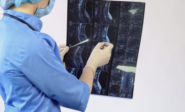 Diagnóza „cervikálnej osteochondrózy sa stanovuje na základe štúdie MRI