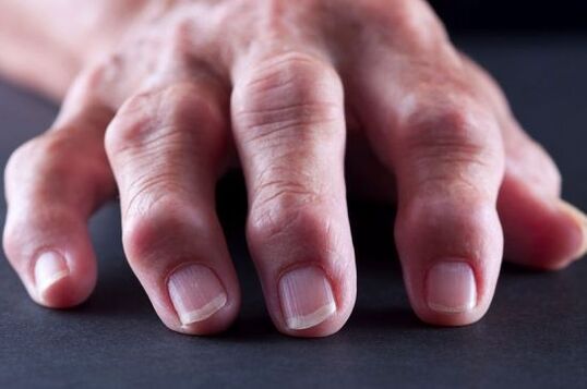 Kĺbové deformity prstov v dôsledku artrózy alebo artritídy